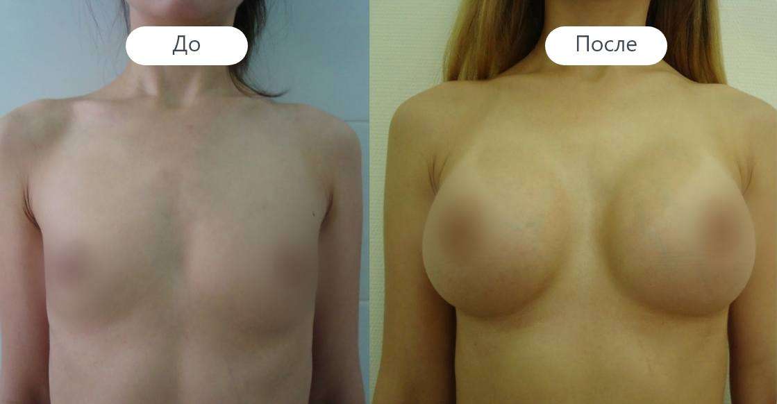 Увеличение груди до и после